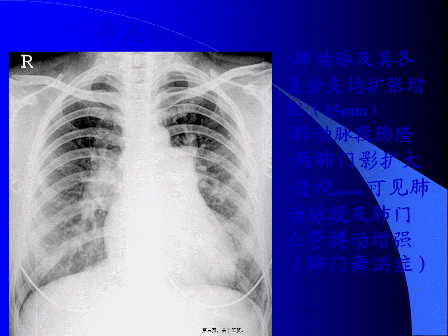 2022年医学专题—肺充血与肺淤血区别(1).ppt_第3页