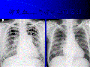 2022年医学专题—肺充血与肺淤血区别(1).ppt