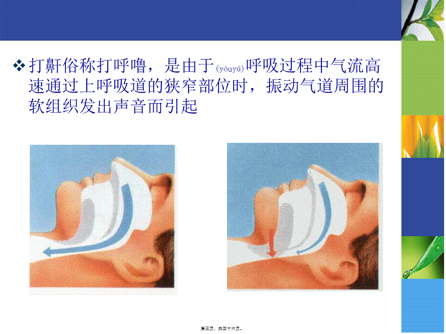 2022年医学专题—打鼾与睡眠呼吸暂停综合征(1).ppt_第3页