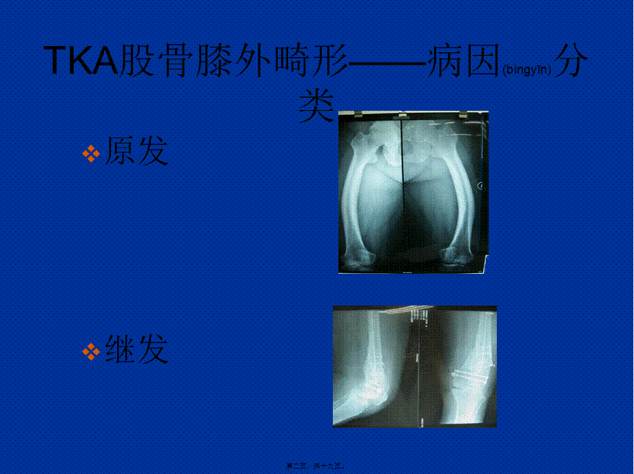 2022年医学专题—股骨侧膝外畸形的人工全膝关节置换术概要(1).ppt_第2页