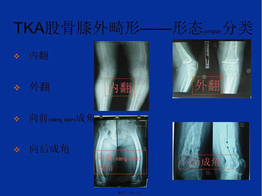 2022年医学专题—股骨侧膝外畸形的人工全膝关节置换术概要(1).ppt_第3页