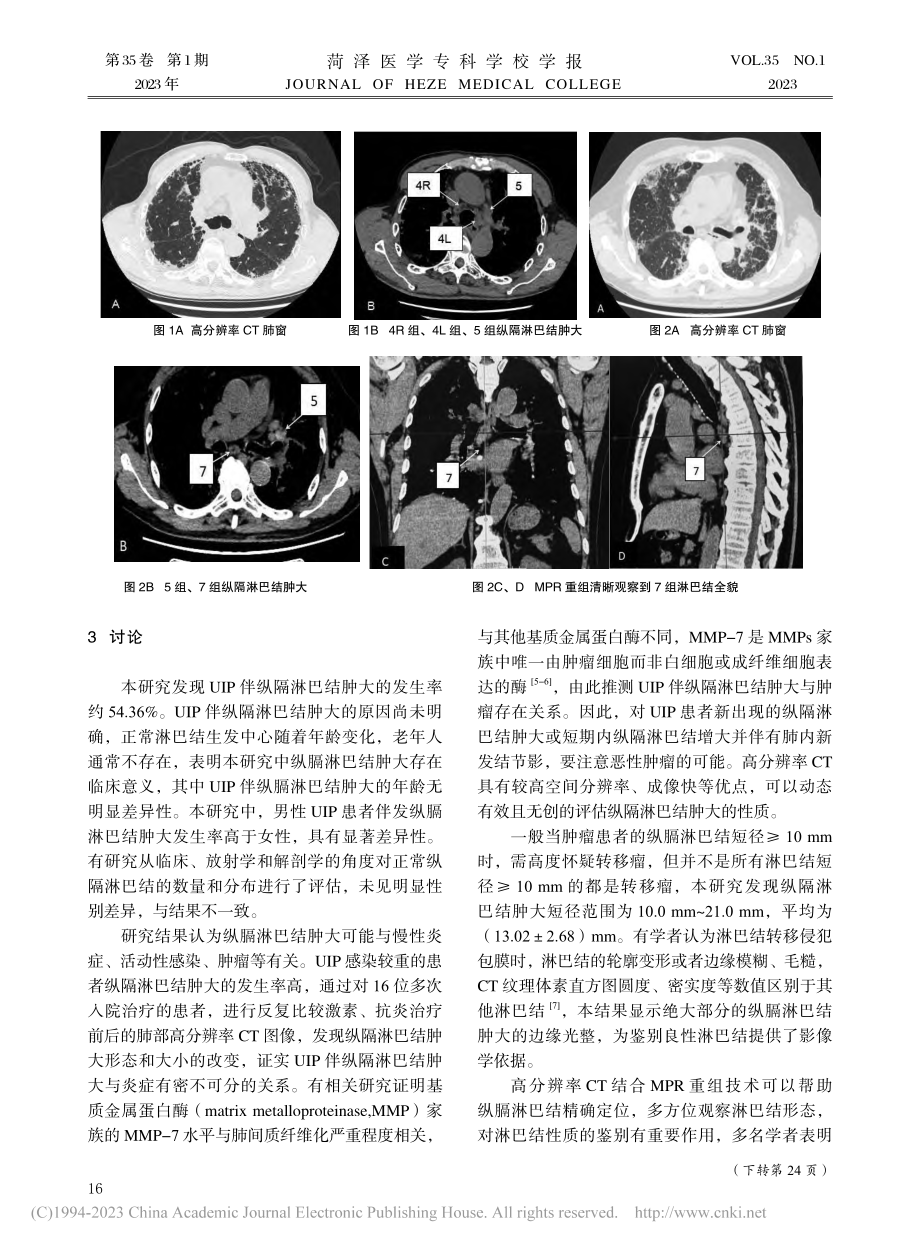 高分辨率CT诊断普通间质性...伴纵隔淋巴结肿大的应用研究_李韶铭.pdf_第3页