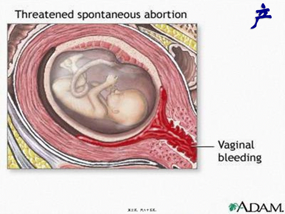 2022年医学专题—不全流产(1).ppt_第3页