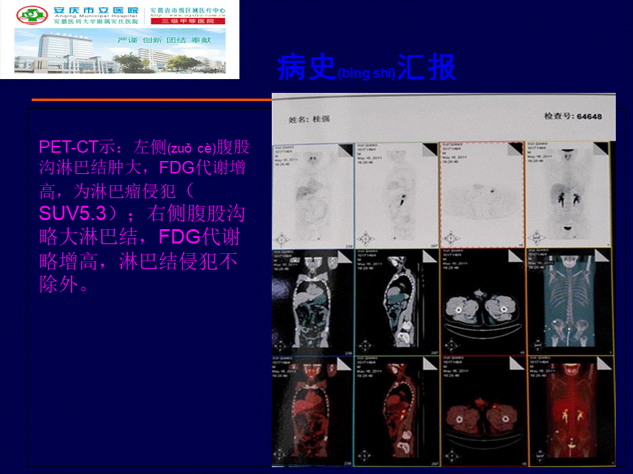 2022年医学专题—一例初诊难治MM的诊治-安庆立医院(1).ppt_第3页