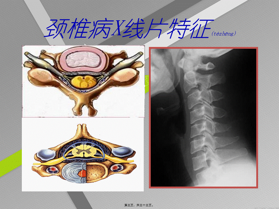 2022年医学专题—神经根性颈椎病(1).ppt_第3页