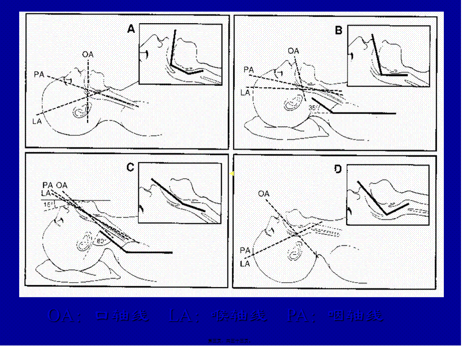 困难气管插管术(1).pptx_第3页