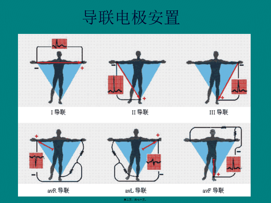 冠心病的心电图表现#(1).pptx_第2页