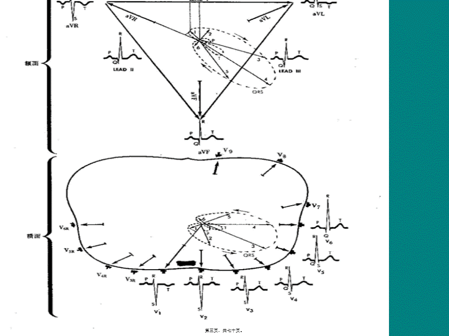 冠心病的心电图表现#(1).pptx_第3页