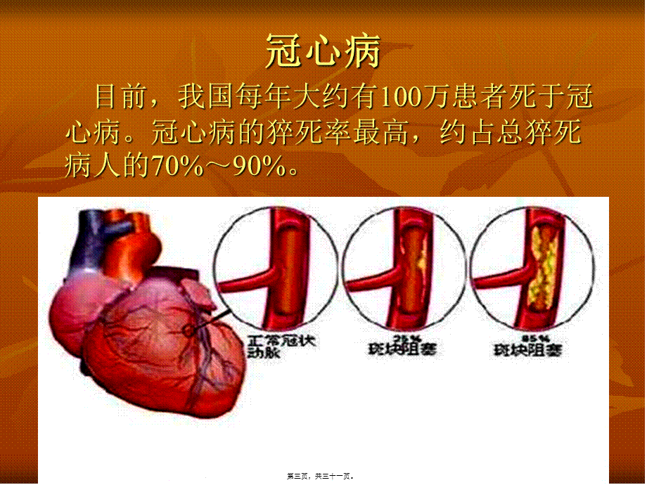 冠心病与猝死幻灯汇总(1).pptx_第3页