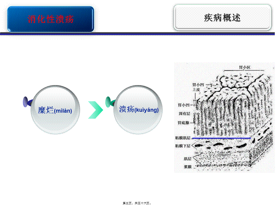 2022年医学专题—消化性溃疡护校(1).ppt_第3页