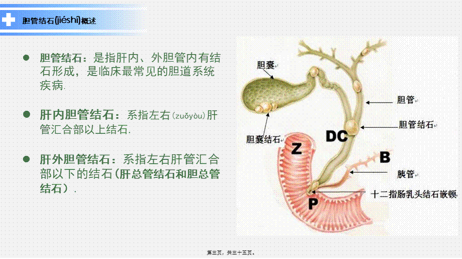 2022年医学专题—周梦娜-胆总管结石(1).pptx_第3页