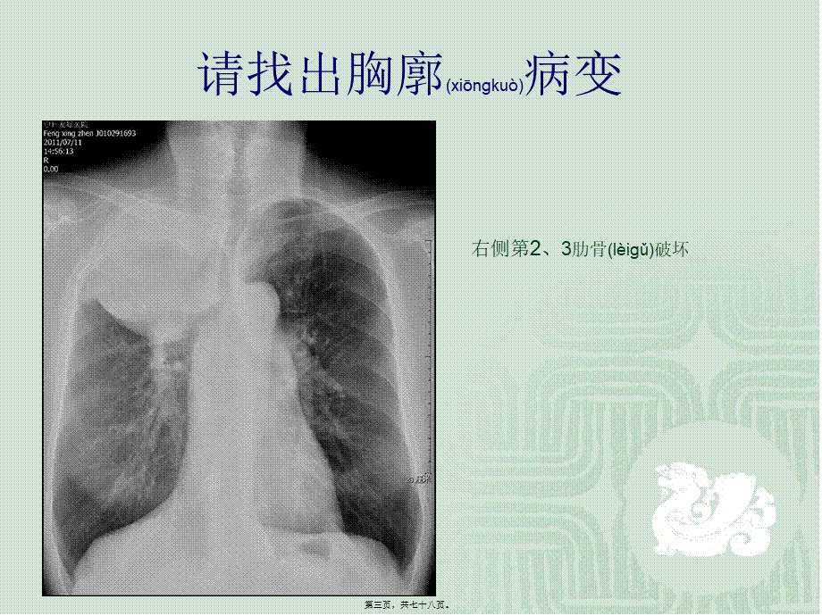 2022年医学专题—胸片读片入门(1).ppt_第3页