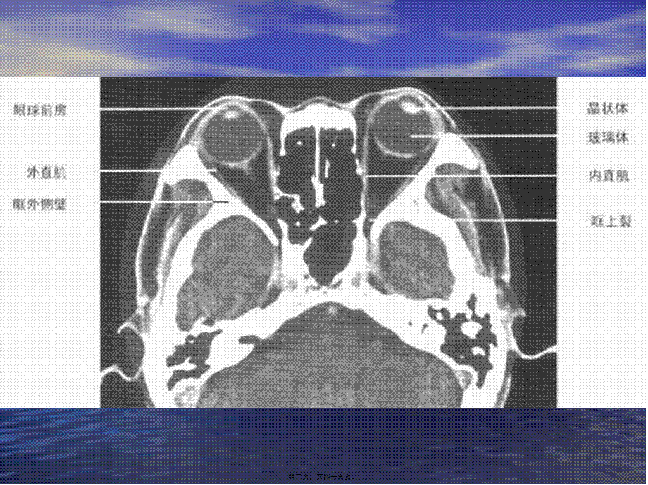 头颈部CT(1).pptx_第3页