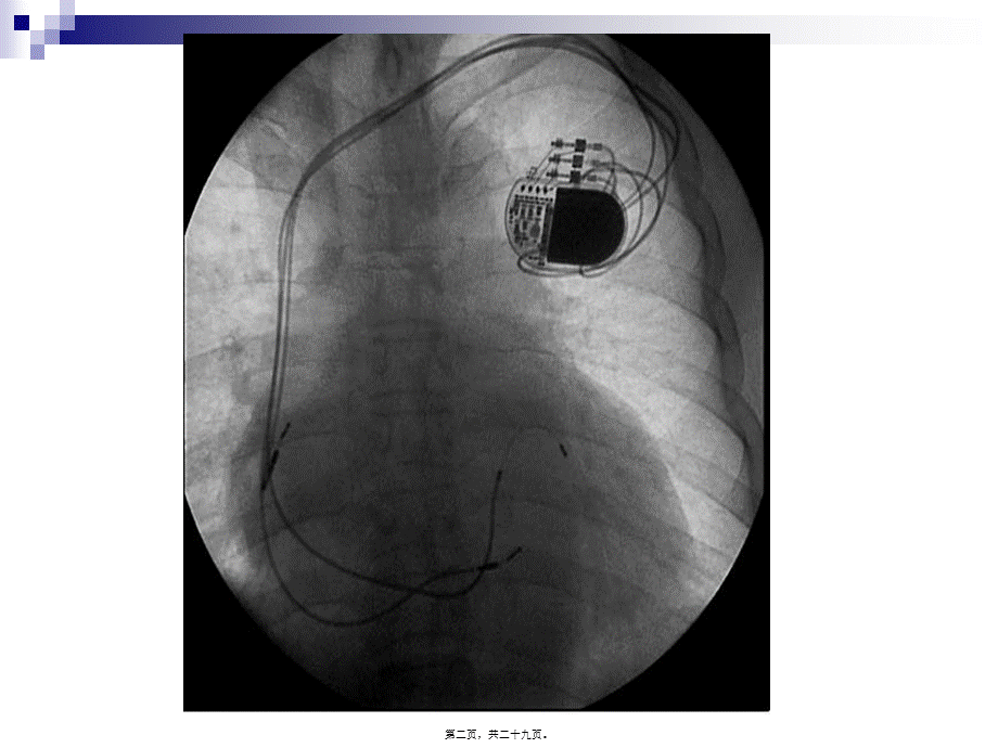 2022年医学专题—心脏起搏器ppt(1).ppt_第2页