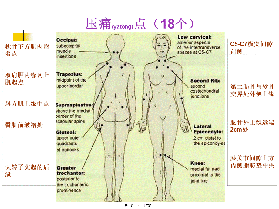 2022年医学专题—纤维肌痛综合征(1).ppt_第3页