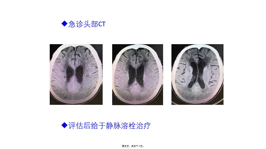 关于静脉溶栓后发生早期神经功能恶化原因探讨(1).pptx_第3页