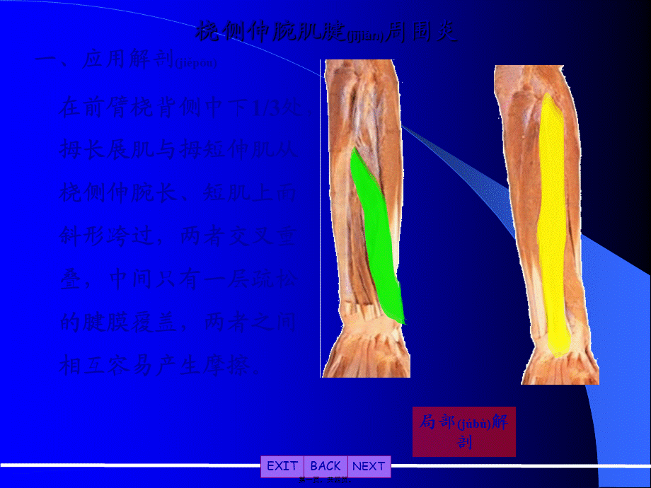 2022年医学专题—桡侧伸腕肌腱周围炎(1).ppt_第1页