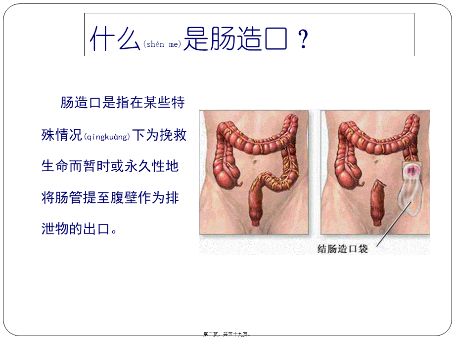 2022年医学专题—肠造口术.ppt_第2页