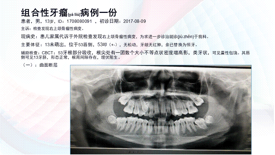 2022年医学专题—牙瘤(1)(1).pptx_第3页