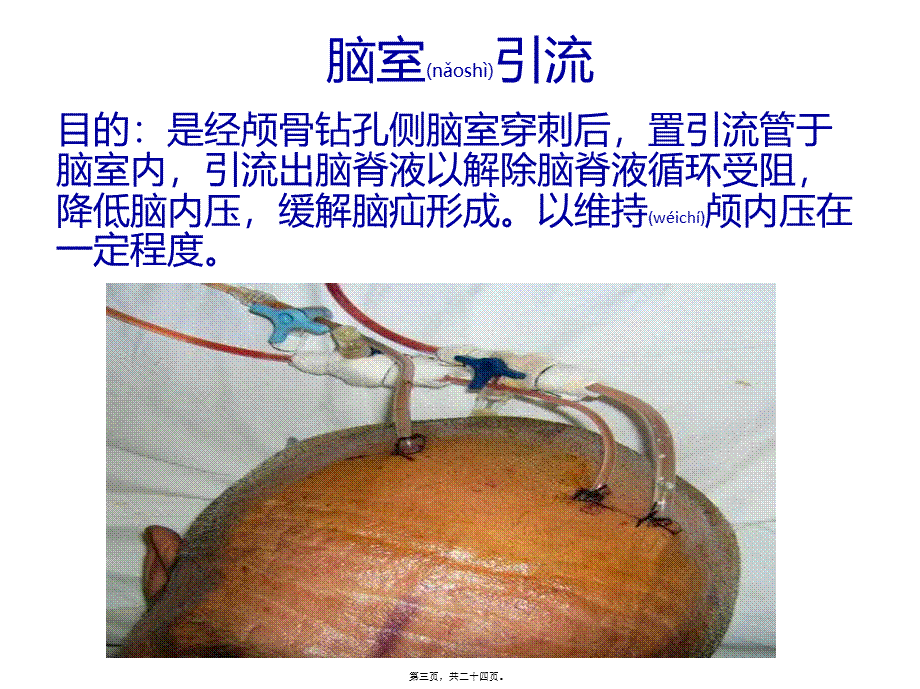 2022年医学专题—脑室引流(1).pptx_第3页