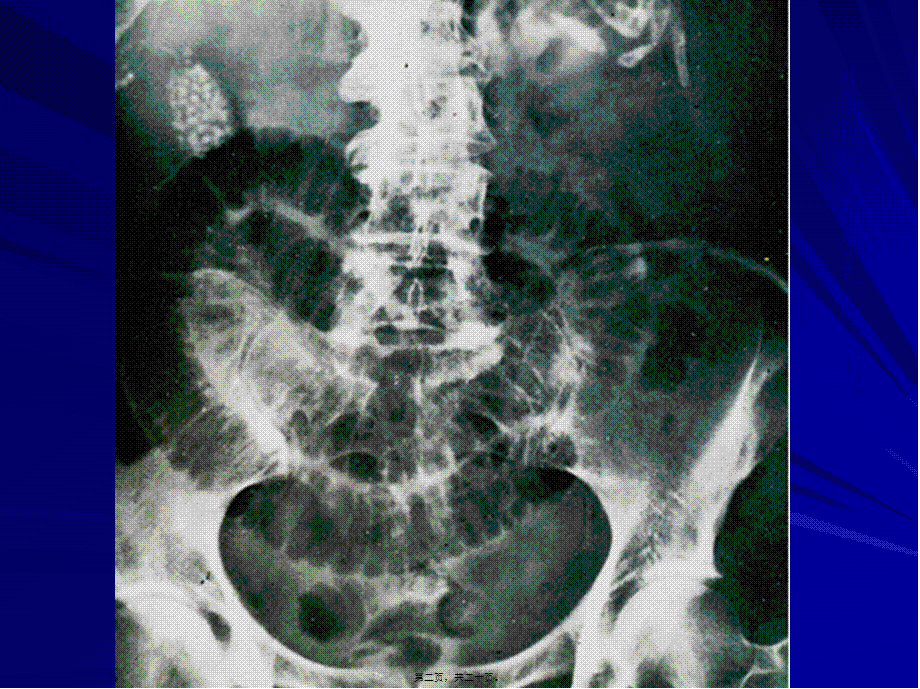 2022年医学专题—炎性肠梗阻.ppt_第2页