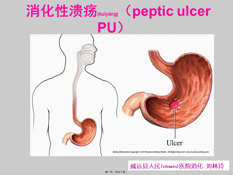 2022年医学专题—消化性溃疡刘林玲.ppt_第1页