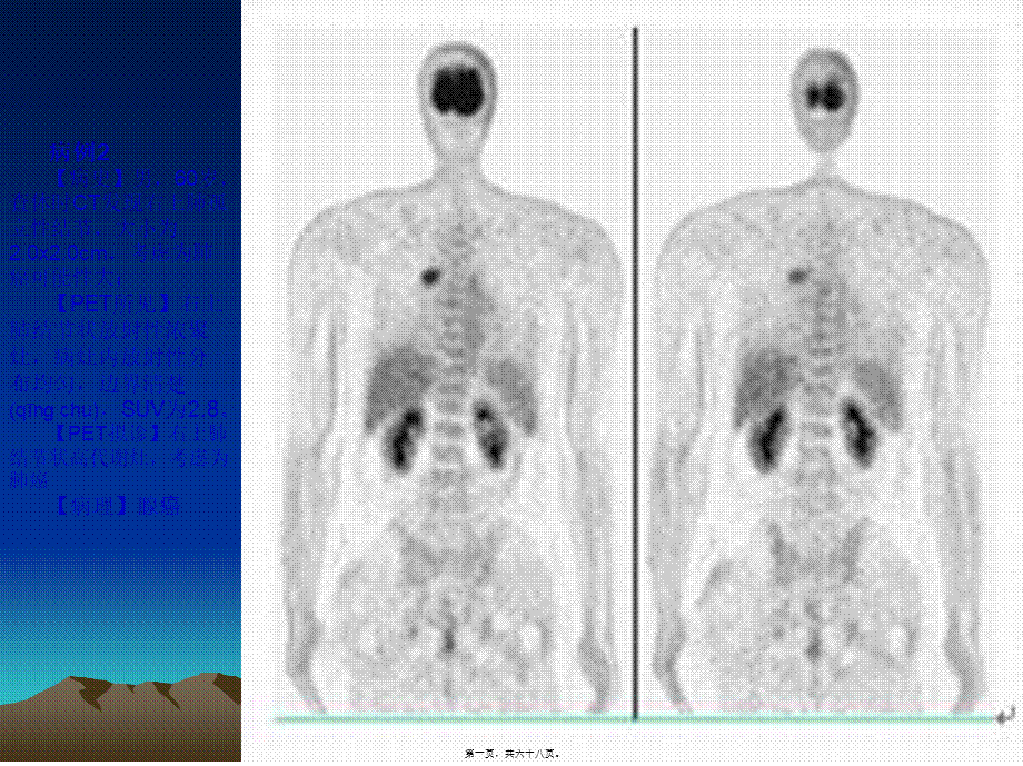 2022年医学专题—最新PET病例-PPT文档(1).ppt_第1页
