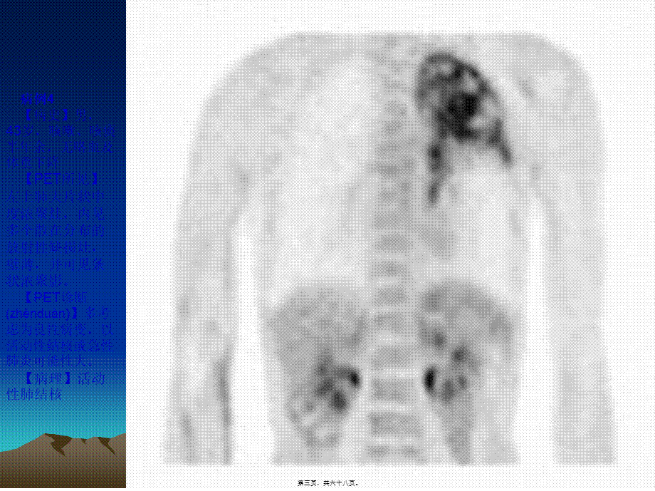 2022年医学专题—最新PET病例-PPT文档(1).ppt_第3页