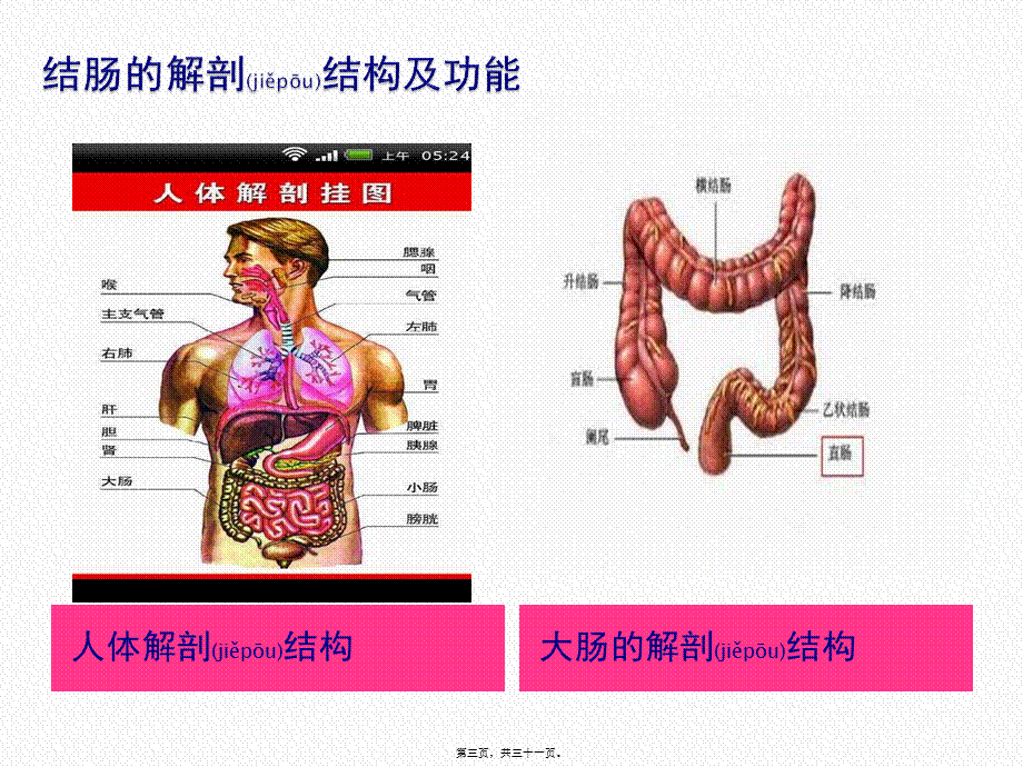 2022年医学专题—溃疡性结肠炎..pptx_第3页