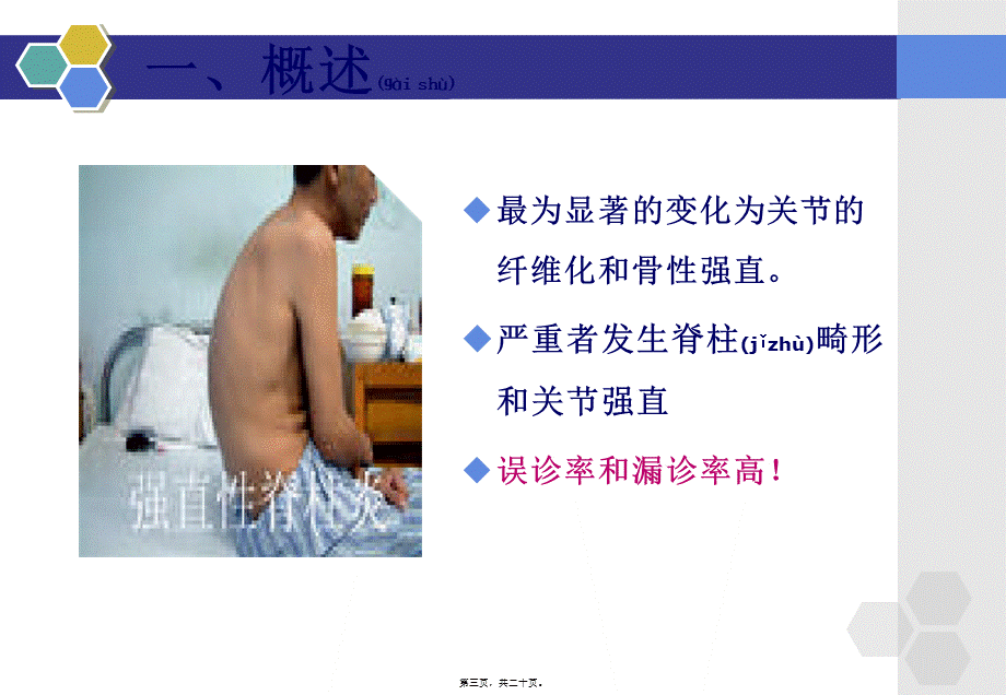 2022年医学专题—强直性脊柱炎的概述..ppt_第3页