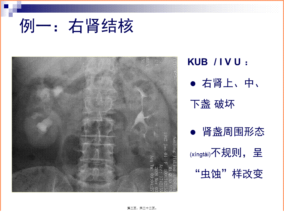 2022年医学专题—泌尿系结核典型病例影像资料(1).ppt_第2页