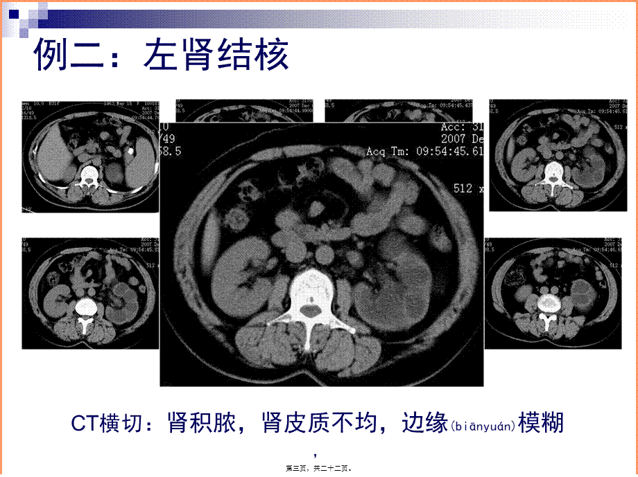 2022年医学专题—泌尿系结核典型病例影像资料(1).ppt_第3页