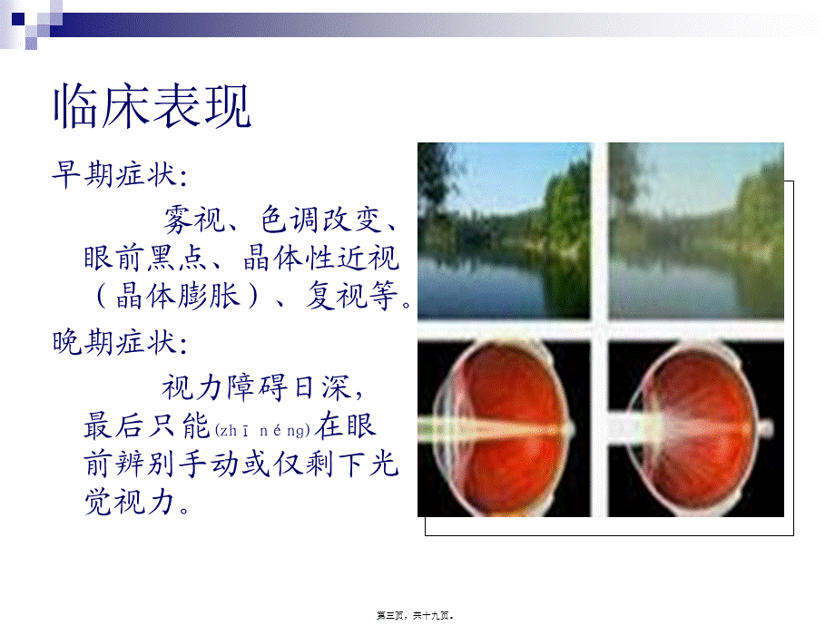 2022年医学专题—老年性白内障的诊(1).ppt_第3页