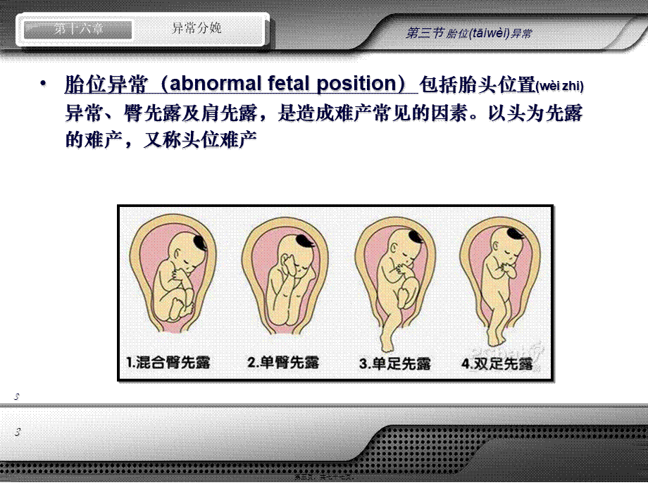 2022年医学专题—异常分娩-胎位异常(1).ppt_第3页