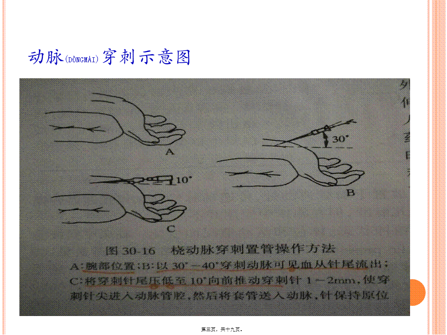 2022年医学专题—动脉穿刺置管与血压测定.pptx_第3页