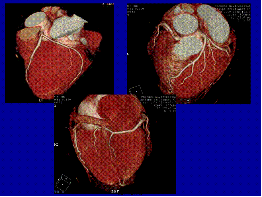 冠状动脉CTA成像.pptx_第3页