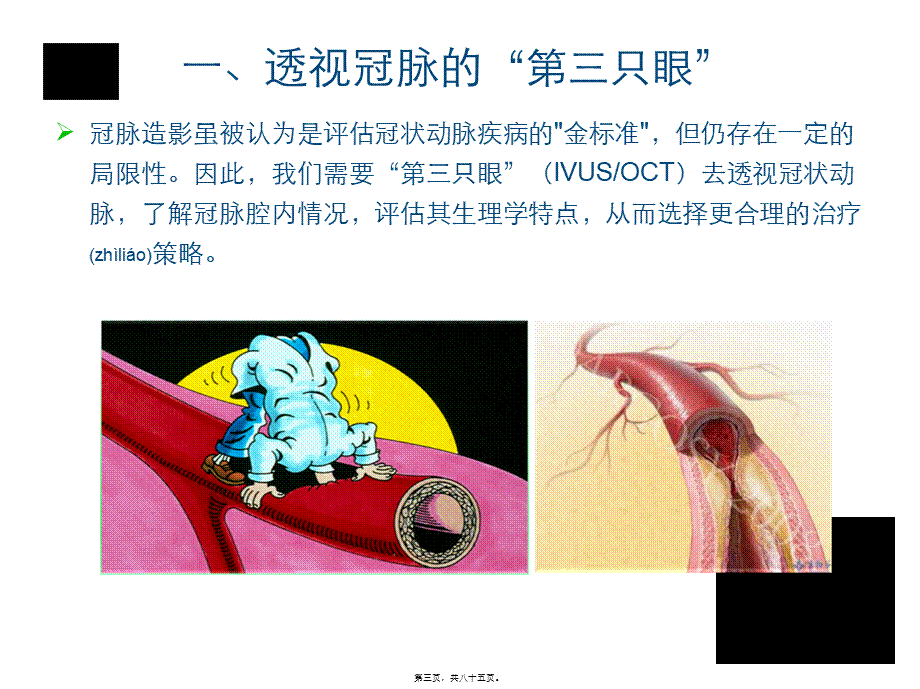 2022年医学专题—第三只眼看冠脉(1).ppt_第3页