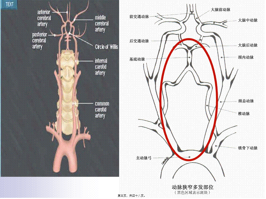 2022年医学专题—后循环缺血专家共识(1).ppt_第3页