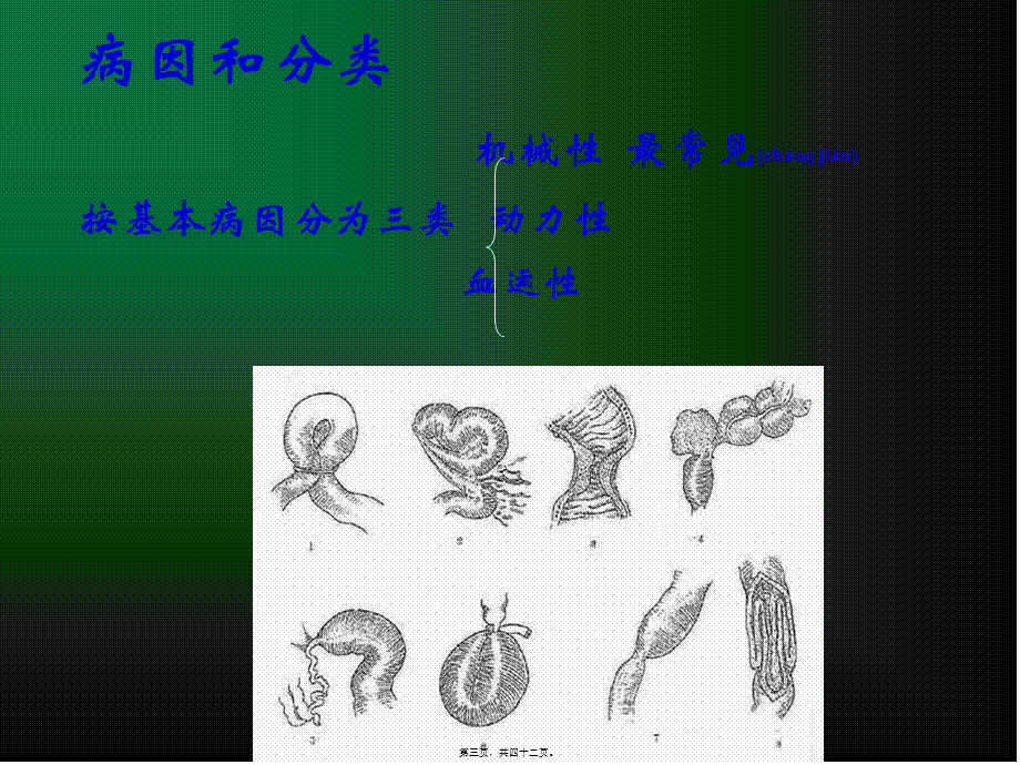 2022年医学专题—第五版-肠梗阻(1).ppt_第3页
