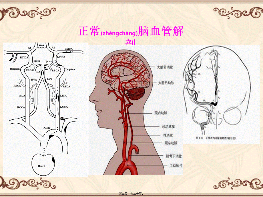 2022年医学专题—如何正确认识脑梗塞...ppt_第3页