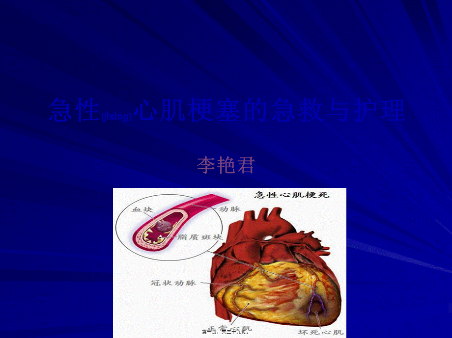 2022年医学专题—急性心肌梗死2.ppt_第1页