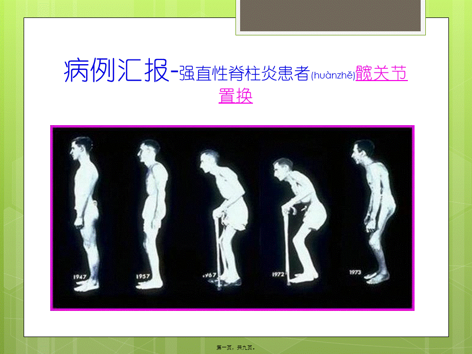 2022年医学专题—病例分析—强直性脊柱炎(1).pptx_第1页