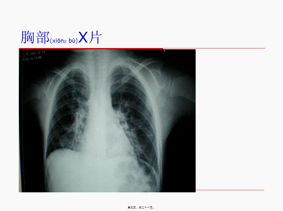 2022年医学专题—儿童甲型H1N1重症诊治探讨.ppt_第3页