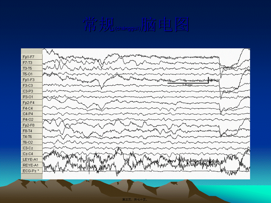 2022年医学专题—振幅整合脑电-卢伟能(1).ppt_第3页