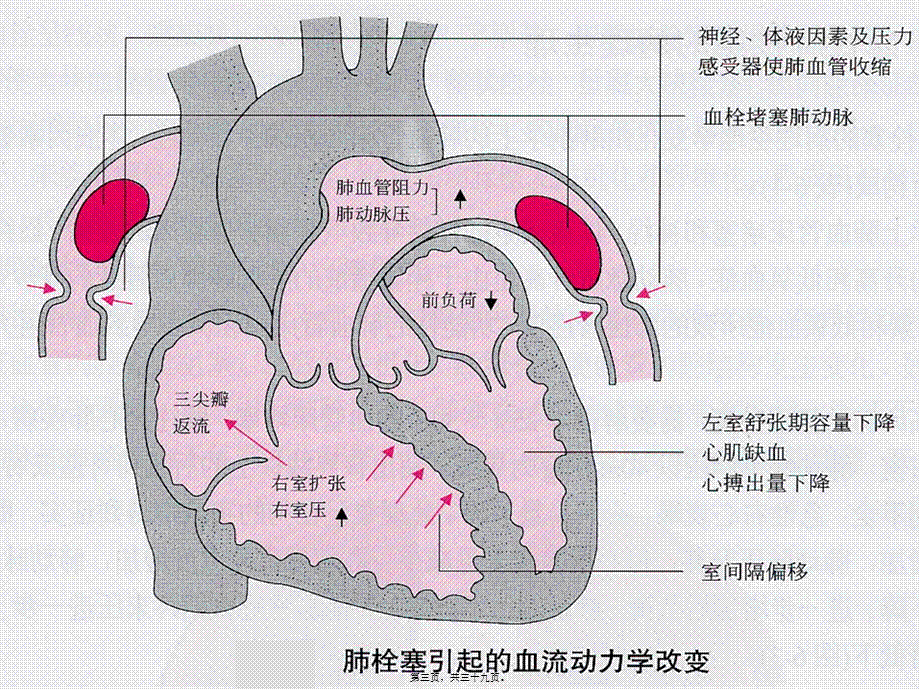 2022年医学专题—肺栓塞[1](1).ppt_第3页