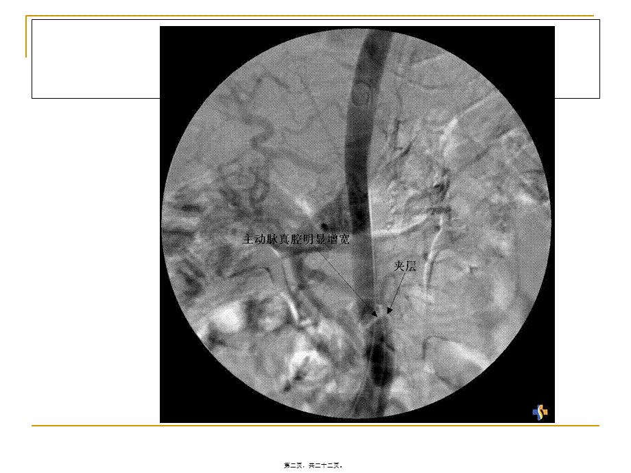 2022年医学专题—主动脉夹层剖析.ppt_第2页