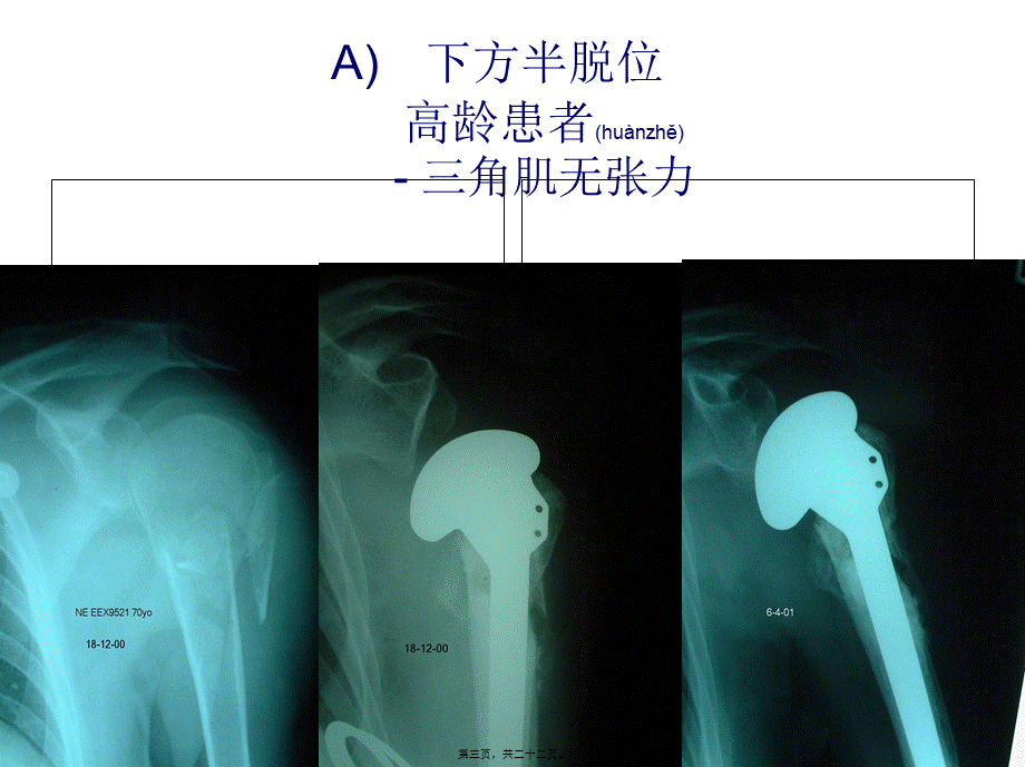 2022年医学专题—肱骨近端骨折的并发症和后遗症---2.ppt_第3页