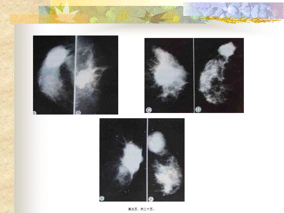 乳腺癌的X线影像学表现.pptx_第3页