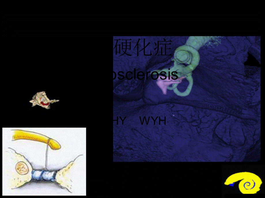 2022年医学专题—耳硬化症考讲诉(1).ppt_第1页