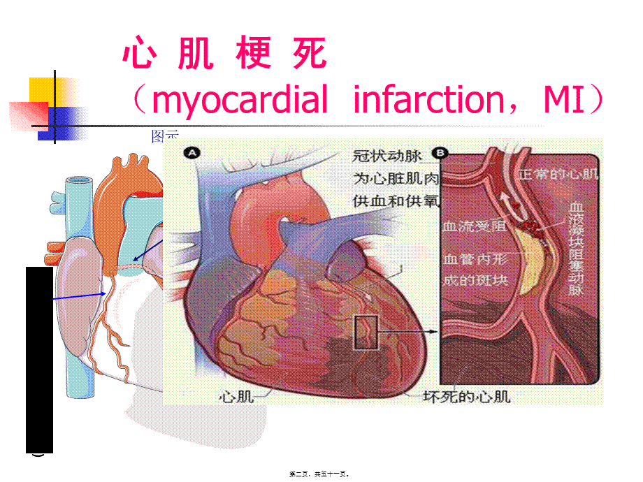 2022年医学专题—急性心肌梗死.pptx_第2页